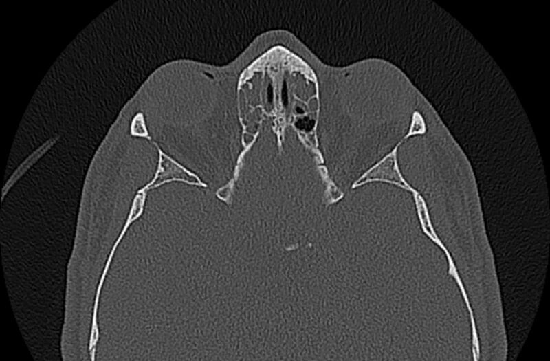 File:Chronic rhinosinusitis (Radiopaedia 65079-74075 Axial bone window 60).jpg