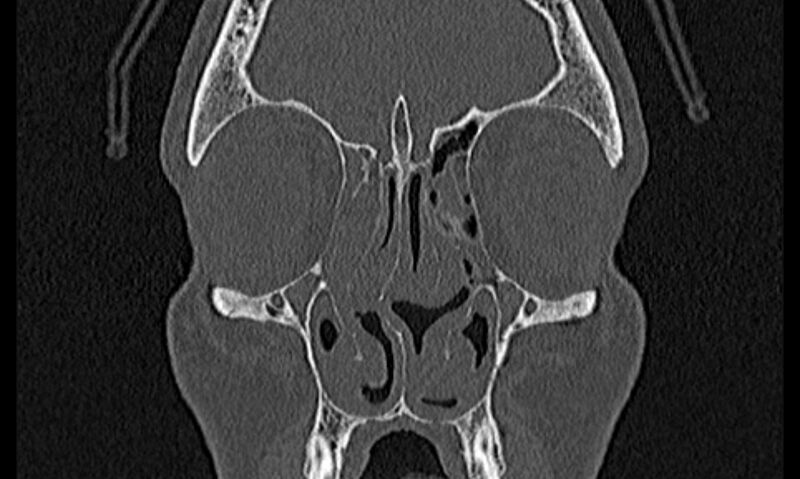 File:Chronic rhinosinusitis (Radiopaedia 65079-74075 Coronal bone window 23).jpg