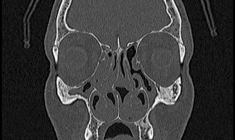 File:Chronic rhinosinusitis (Radiopaedia 65079-74075 Coronal bone window 29).jpg