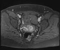 Class II Mullerian duct anomaly- unicornuate uterus with rudimentary horn and non-communicating cavity (Radiopaedia 39441-41755 Axial T1 fat sat 80).jpg