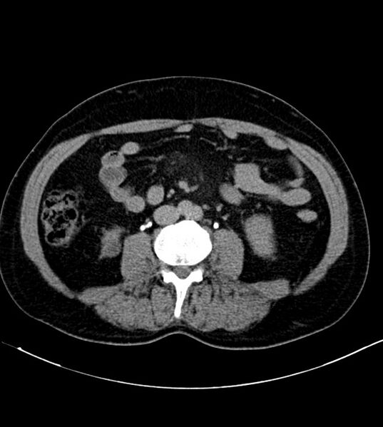 File:Clear cell renal cell carcinoma (Radiopaedia 85006-100539 H 28).jpg