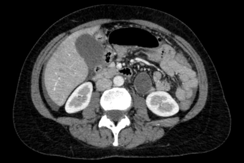 File:Closed loop small bowel obstruction (Radiopaedia 71211-81508 A 54).jpg