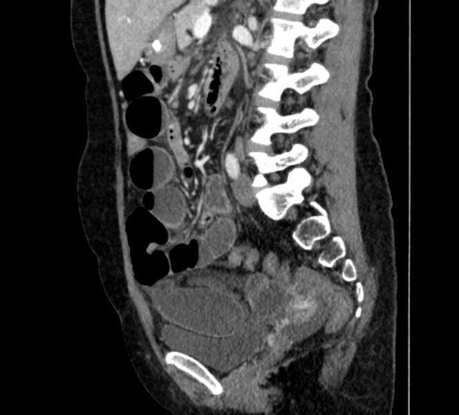 File:Closed loop small bowel obstruction (Radiopaedia 71211-81508 C 88).jpg
