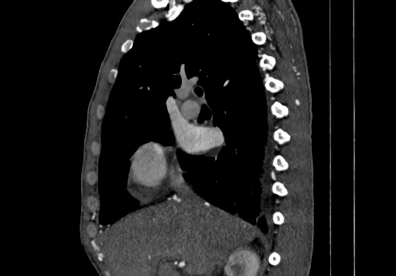 File:Coarctation of aorta with aortic valve stenosis (Radiopaedia 70463-80574 B 2).jpg
