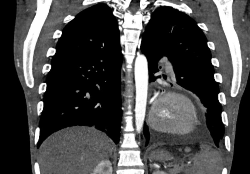 File:Coarctation of aorta with aortic valve stenosis (Radiopaedia 70463-80574 C 168).jpg