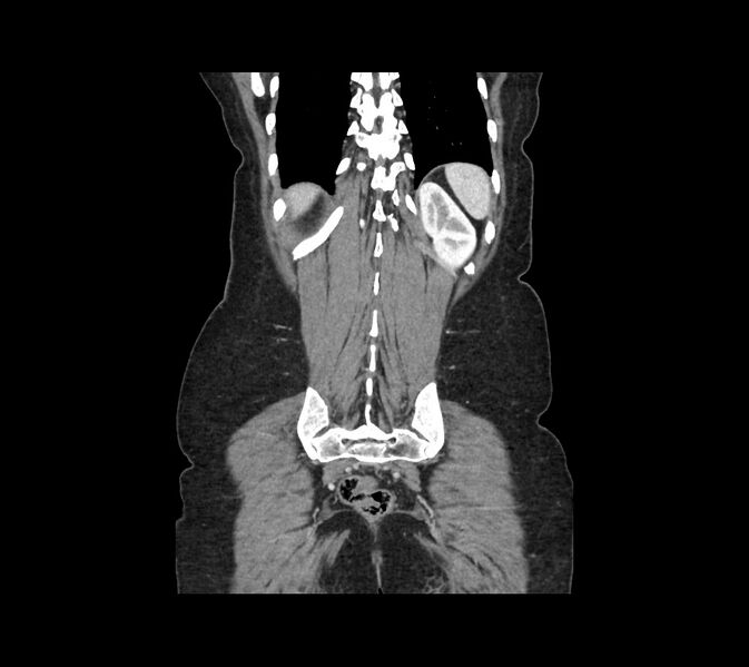 File:Cocoon abdomen with possible tubo-ovarian abscess (Radiopaedia 46235-50636 B 45).jpg