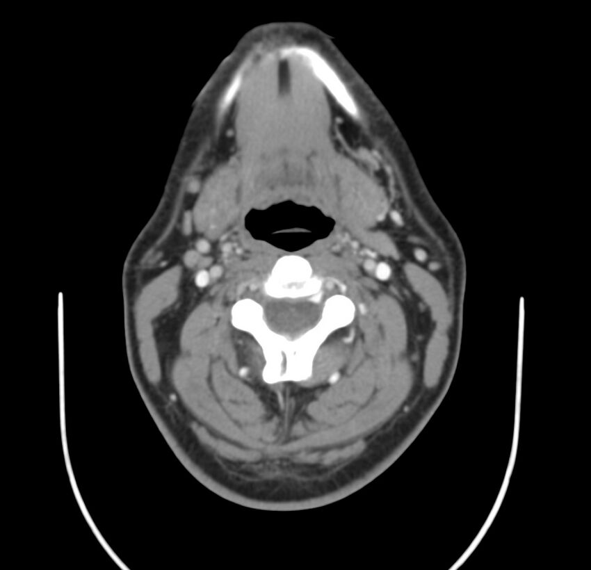 Colloid cyst of thyroid (Radiopaedia 22897-22923 Axial C+ delayed 33).jpg