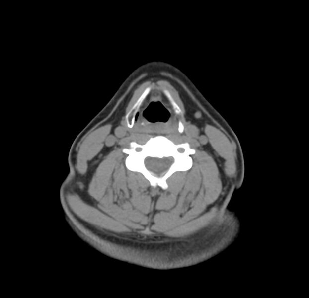 File:Colloid cyst of thyroid (Radiopaedia 22897-22923 Axial non-contrast 29).jpg
