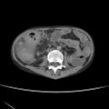 Colocolic fistula - Crohn disease (Radiopaedia 57063-63955 A 41).jpg