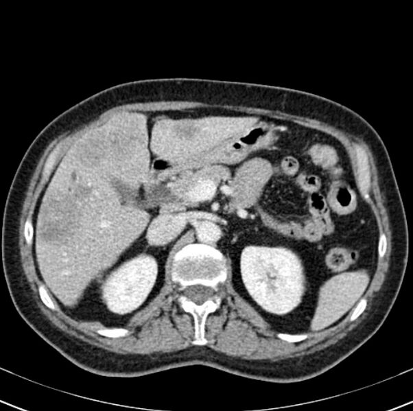 File:Colon carcinoma with hepatic metastases (Radiopaedia 29477-29961 A 37).jpg
