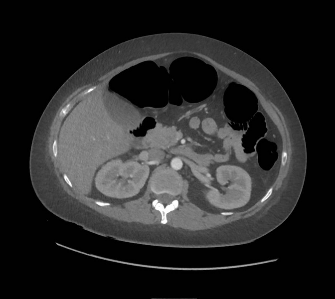 File:Colonic pseudo-obstruction (Radiopaedia 79752-92980 A 69).png