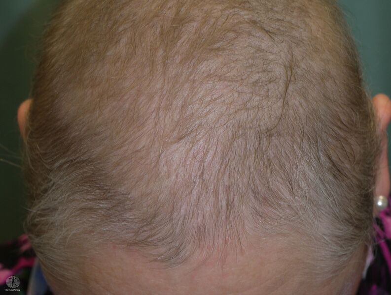 File:Drug-induced diffuse alopecia (DermNet NZ drug-alopecia-9).jpg