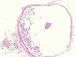 pathology-Bronchogenic cyst