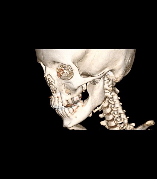 File:Nasoorbitoethmoid fracture (Radiopaedia 90044-107205 3D VRT 29).jpg