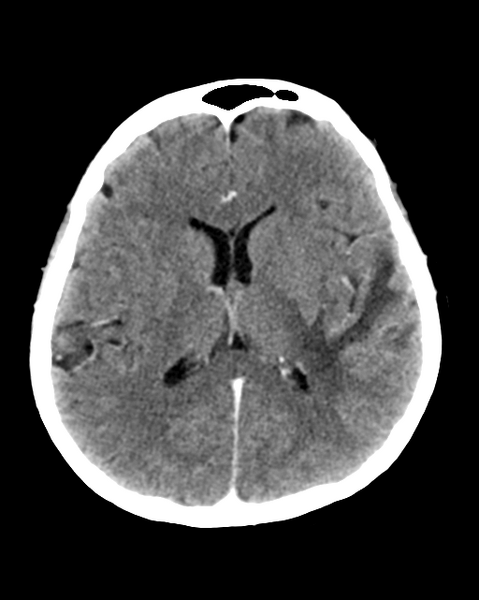 File:Nasopharyngeal carcinoma with cerebral abscess (Radiopaedia 43018-46275 Axial C+ delayed 29).png