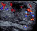 Neonatal mastitis with abscess (Radiopaedia 47089-51629 F 1).jpg