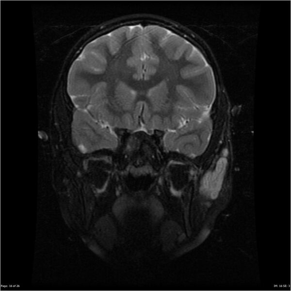 File:Neurofibromatosis type 1 (Radiopaedia 22541-22564 C 16).jpg