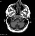 Neurosarcoidosis (Radiopaedia 10930-17204 Axial T1 2).jpg