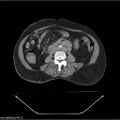 Non-Hodgkin lymphoma (Radiopaedia 27492-27690 B 3).jpg