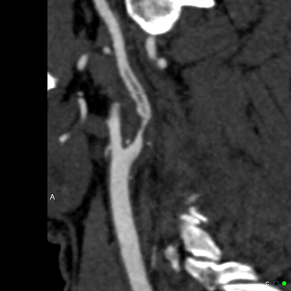 File:Non-occlusive intraluminal internal carotid artery thrombus (Radiopaedia 37751-39658 A 57).jpg