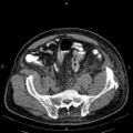 Non Hodgkin lymphoma in a patient with ankylosing spondylitis (Radiopaedia 84323-99621 Axial non-contrast 50).jpg