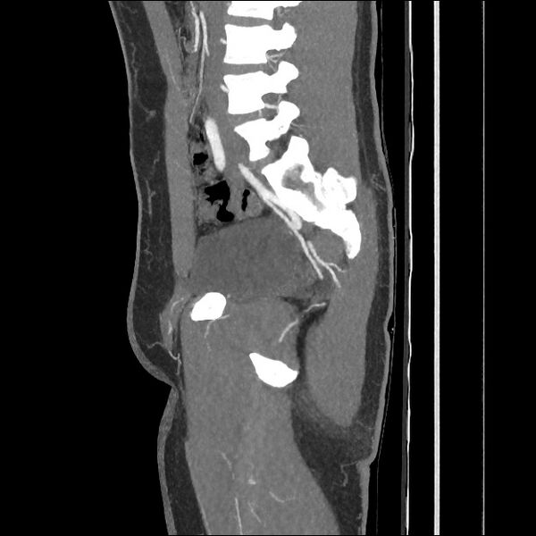 File:Normal CT angiogram of pelvis (Radiopaedia 45390-49430 C 29).jpg