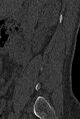 Normal CT lumbar spine (Radiopaedia 53981-60118 Sagittal bone window 3).jpg