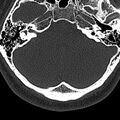 Normal CT of the cervical spine (Radiopaedia 53322-59305 Axial bone window 7).jpg