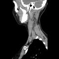 Normal CT of the neck (Radiopaedia 14575-14500 Sagittal C+ 13).jpg