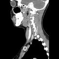 Normal CT of the neck (Radiopaedia 14575-14500 Sagittal C+ 18).jpg
