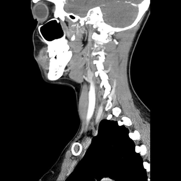 File:Normal CT of the neck (Radiopaedia 14575-14500 Sagittal C+ 18).jpg