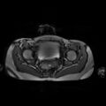 Normal MRI abdomen in pregnancy (Radiopaedia 88001-104541 Axial Gradient Echo 52).jpg