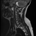 Normal cervical and thoracic spine MRI (Radiopaedia 35630-37156 Sagittal T2 2).png