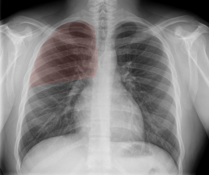 File:Normal chest x-ray - lobes (illustration) (Radiopaedia 58938-66192 I 1).png