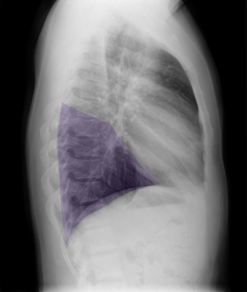 File:Normal chest x-ray - lobes (illustration) (Radiopaedia 58938-66192 M 1).png
