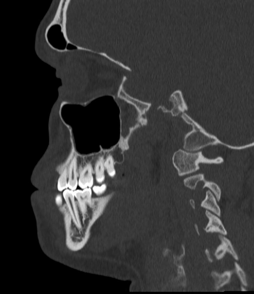 Normal facial bone CT (Radiopaedia 88742-105476 Sagittal bone window 108).jpg