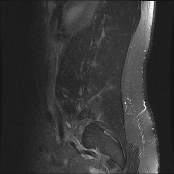 File:Normal lumbar spine MRI (Radiopaedia 43051-46311 Sagittal STIR 18).jpg
