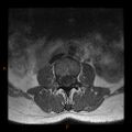 Normal spine MRI (Radiopaedia 77323-89408 Axial T1 4).jpg