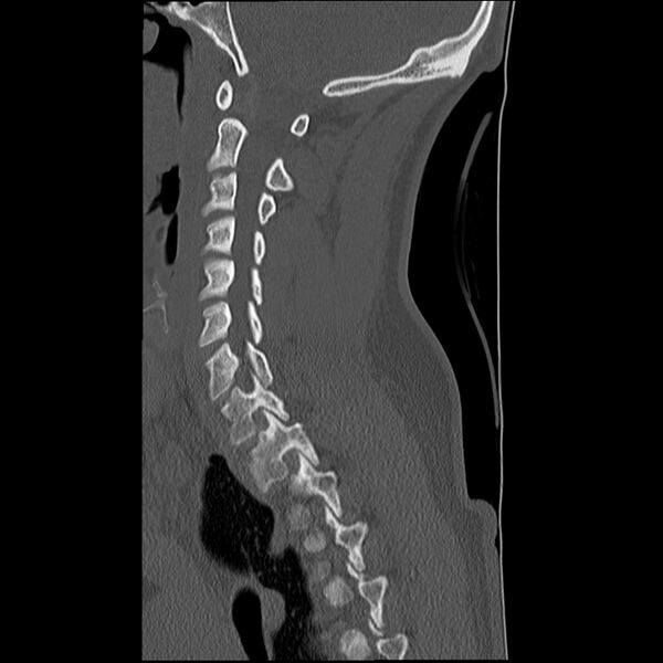 File:Normal trauma spine imaging (Radiopaedia 31753-32686 Sagittal bone window 15).jpg