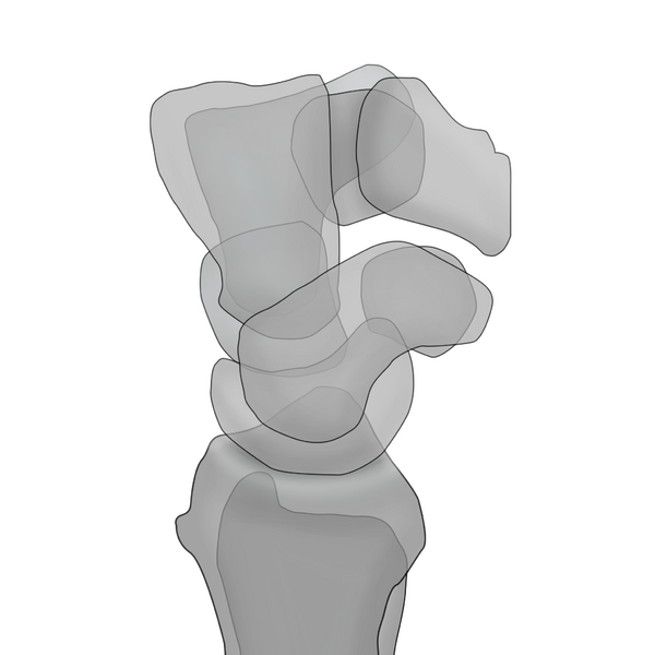 File:Normal wrist alignment, dorsal and volar intercalated segmental instability (illustration) (Radiopaedia 80949-94489 A 1).png