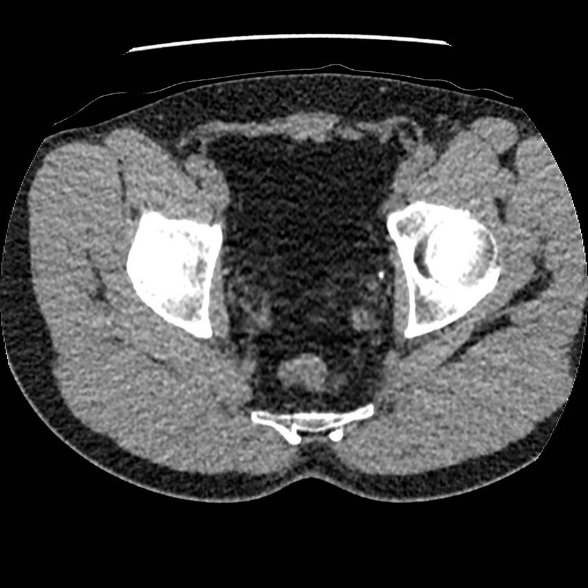 Obstructing ureteric calculus and ureteric anatomy (Radiopaedia 62730-71042 Axial non-contrast 154).jpg