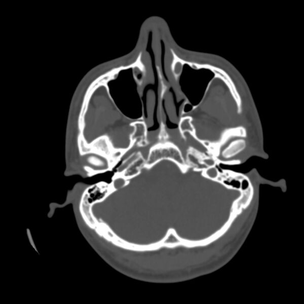 File:Occipital spur - asymptomatic (Radiopaedia 87753-104201 Axial bone window 26).jpg