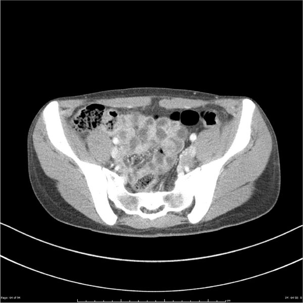 File:Traumatic renal artery dissection and pancreatic transection (Radiopaedia 37061-38739 Axial 238).jpg