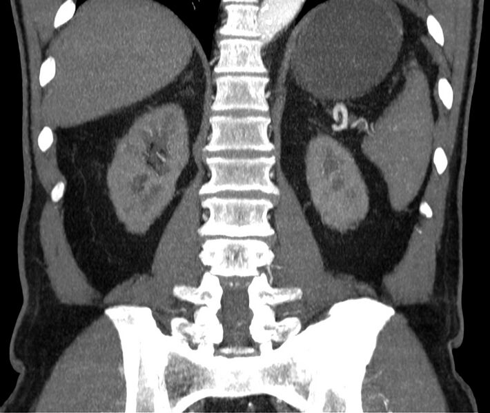 File:Abdominal aortic aneurysm (Radiopaedia 22421-22458 C 33).jpg