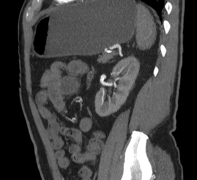 File:Abdominal aortic aneurysm (Radiopaedia 22421-22458 D 34).jpg