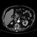 Abdominal aortic aneurysm (Radiopaedia 25855-26001 Axial C+ arterial phase 47).jpg