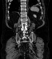 Abdominal aortic aneurysm (Radiopaedia 25855-26001 Coronal C+ arterial phase 64).jpg