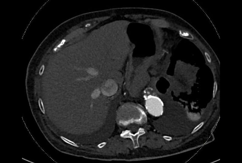 File:Abdominal aortic aneurysm with thrombus fissuration (Radiopaedia 73192-83919 Axial C+ arterial phase 10).jpg