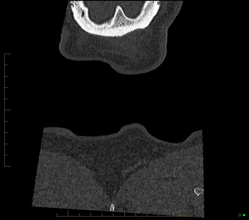 Accessory articulation of cervical transverse processes (Radiopaedia 82715-96933 Coronal non-contrast 137).jpg