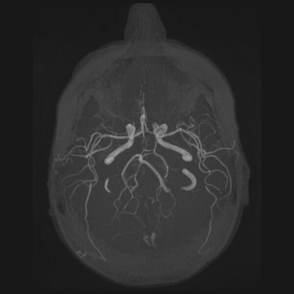 File:Accessory middle cerebral artery and ICA aneurysm (Radiopaedia 22656-22674 B 19).jpg
